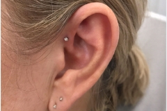 Forward Helix w/ NeoMetal.